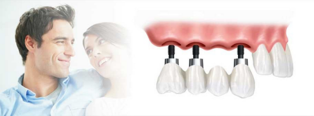 Dental insurance implants coverage